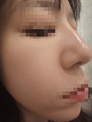 before photo: IPL(光/フォト治療), ピーリング, エレクトロポレーション
