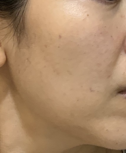 after photo: 스킨보톡스