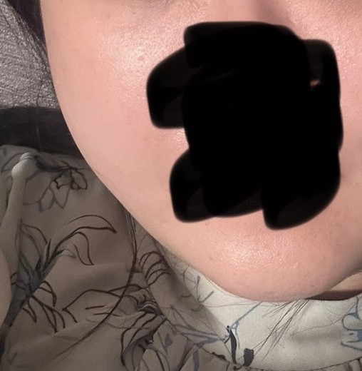 after photo: チタニウムリフト