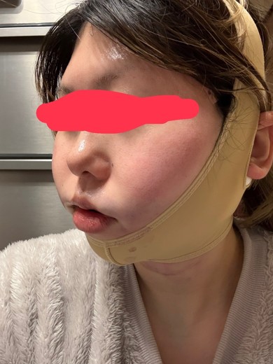 after photo: 糸リフト, 脂肪吸引(顎下), 脂肪吸引(顔), 脂肪吸引(頬)