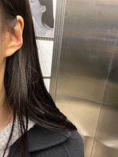 after photo: 캘로이드귀성형