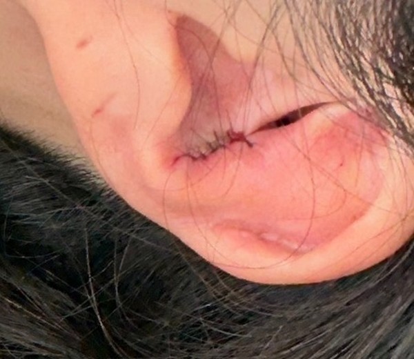 after photo: 캘로이드귀성형