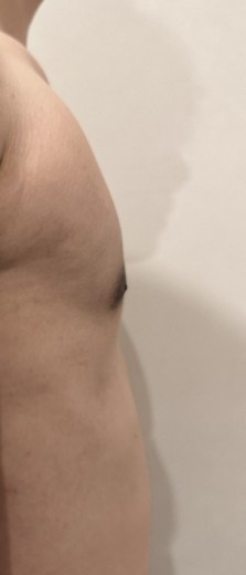 after photo: 여유증수술