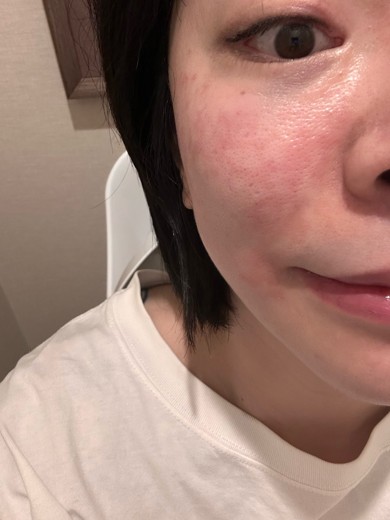 after photo: ジュベルック(Juvelook)