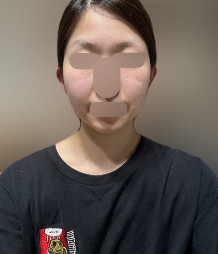 after photo: エラボトックス