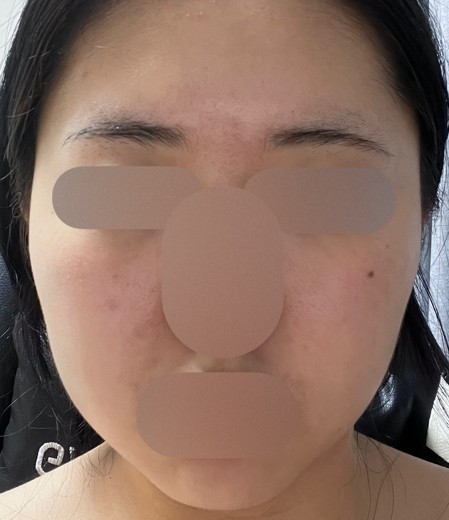 after photo: 윤곽주사, 얼굴지방분해주사