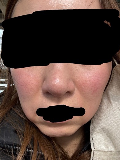 after photo: 脂肪溶解注射(顔)