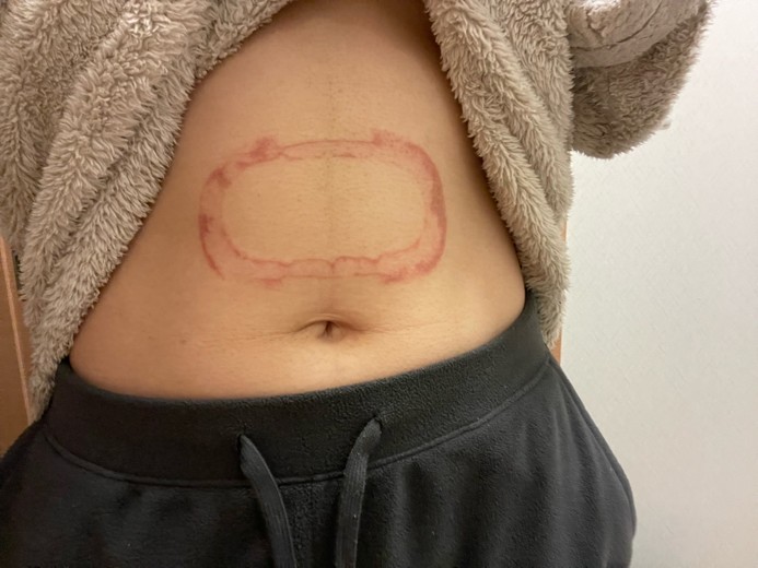 after photo: 脂肪冷却(腹部)