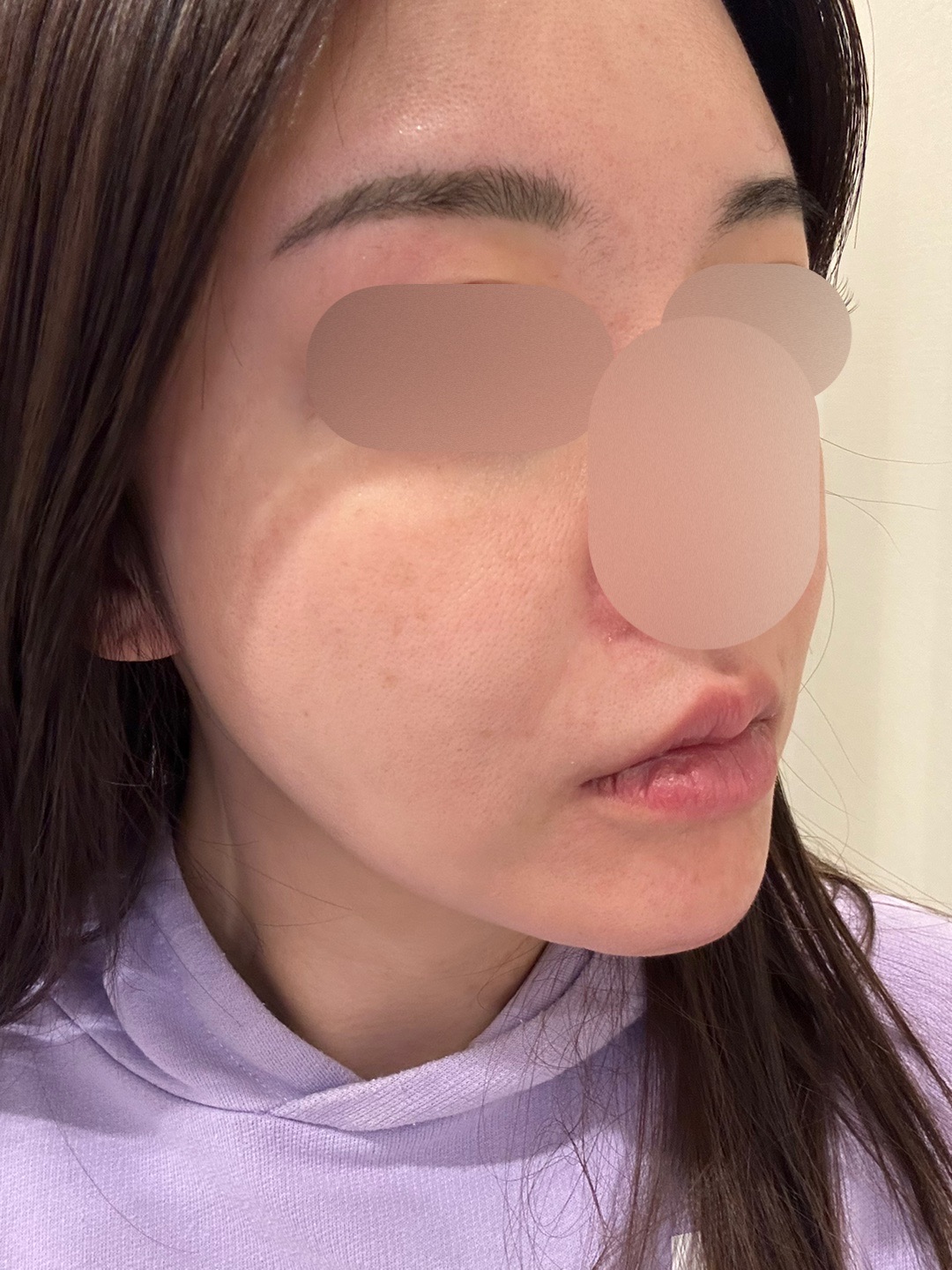 IPL（光治療）全顔2周 ｜ステラM22フォトフェイシャル【12月15日迄にご