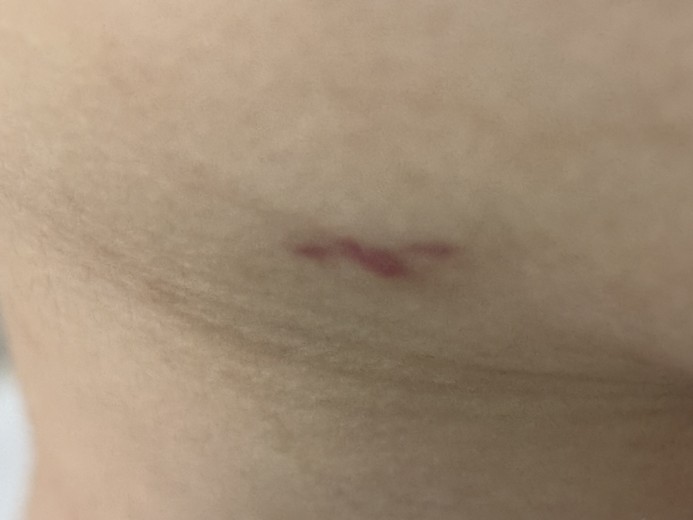 after photo: 팔지방흡입, 옆구리지방흡입, 복부지방흡입, 허리지방흡입