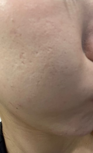 after photo: ダーマペン