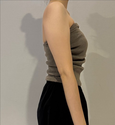 before photo: 팔지방흡입, 부유방흡입