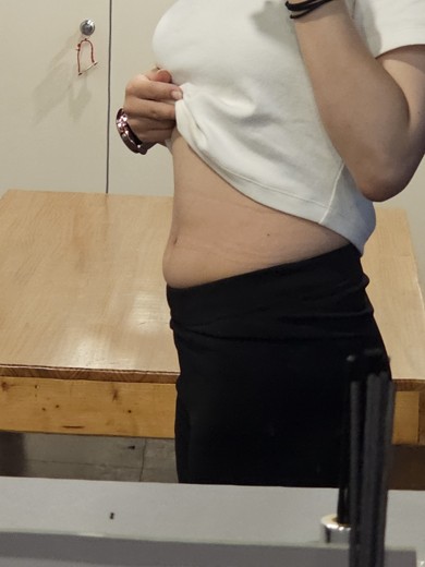 before photo: 복부지방분해주사