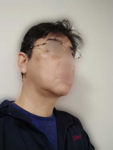 after photo: レーザートーニング