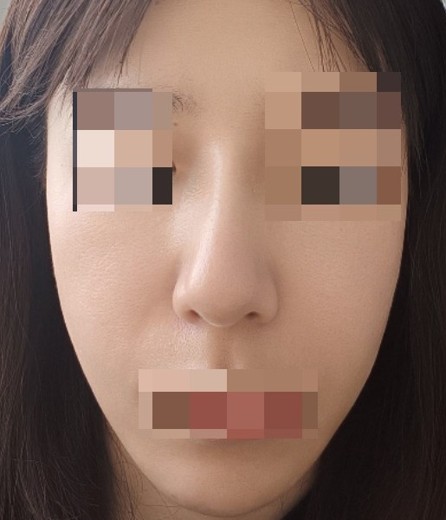 after photo: IPL(光/フォト治療), ピーリング, エレクトロポレーション