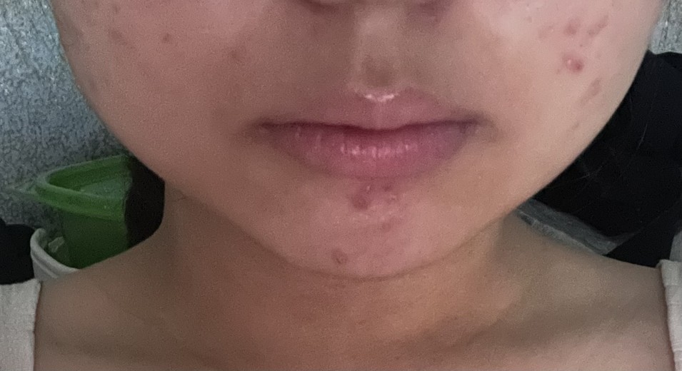 after photo: 윤곽주사, 사각턱보톡스