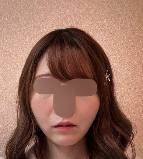 after photo: フラクショナルレーザー, エレクトロポレーション, Qスイッチレーザー