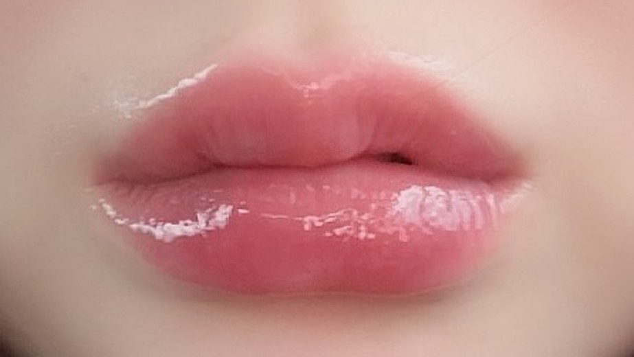 after photo: 입꼬리필러, 입술필러