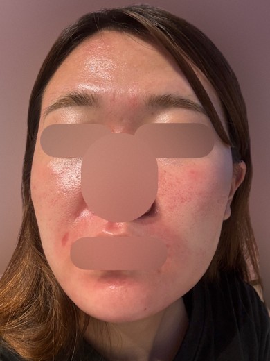 after photo: ヴェルベットスキン