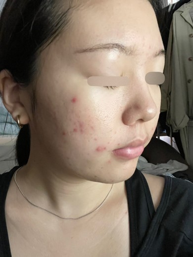 after photo: ピーリング, ララピール(LHAピーリング)