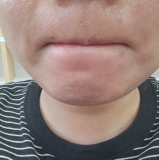 after photo: 아쿠아필링, 수염제모