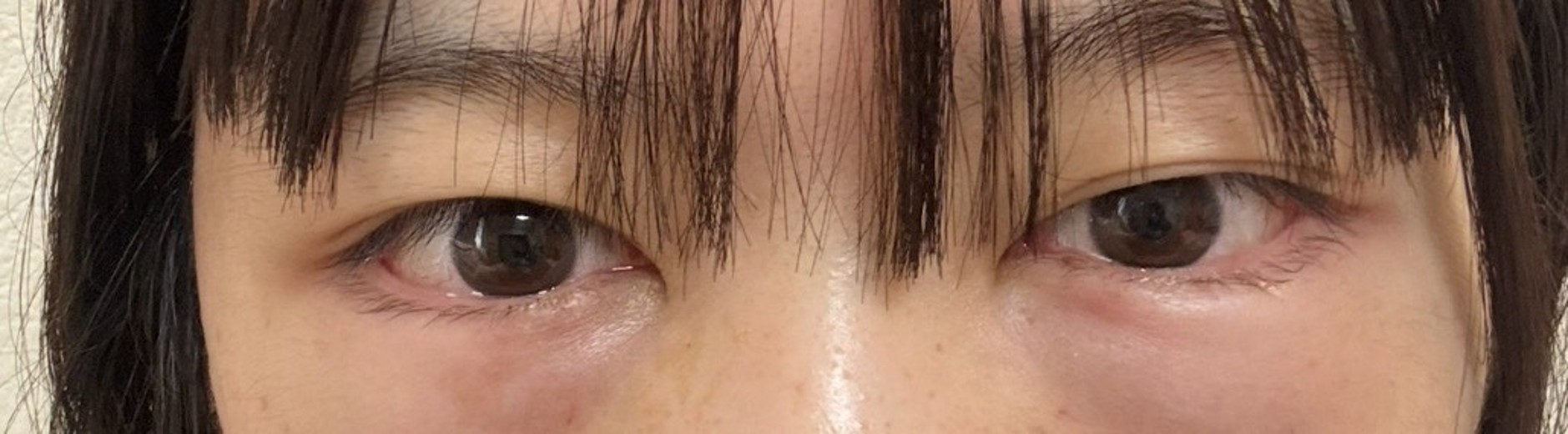 after photo: 目の下脂肪再配置(ハムラ・裏ハムラ法)