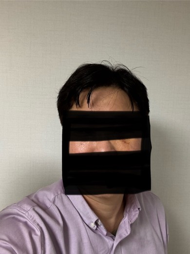 after photo: 눈밑지방재배치