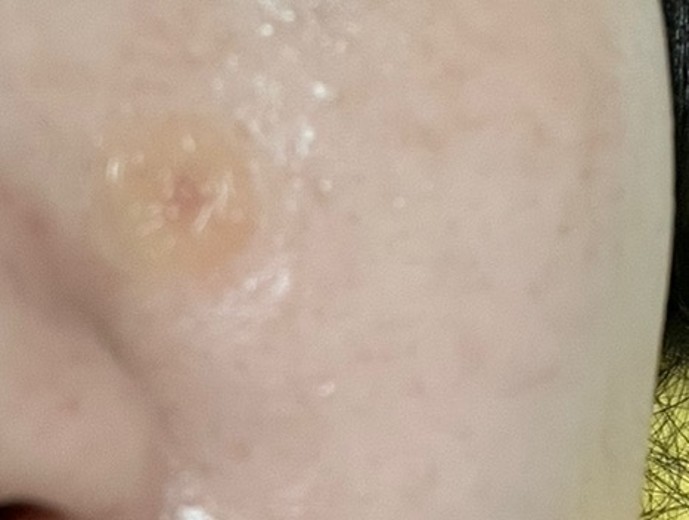 after photo: CO2레이저, 비립종제거, 사마귀제거