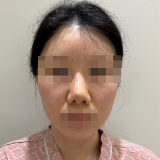 before photo: 코재수술, 콧대(보형물), 복코교정(수술)