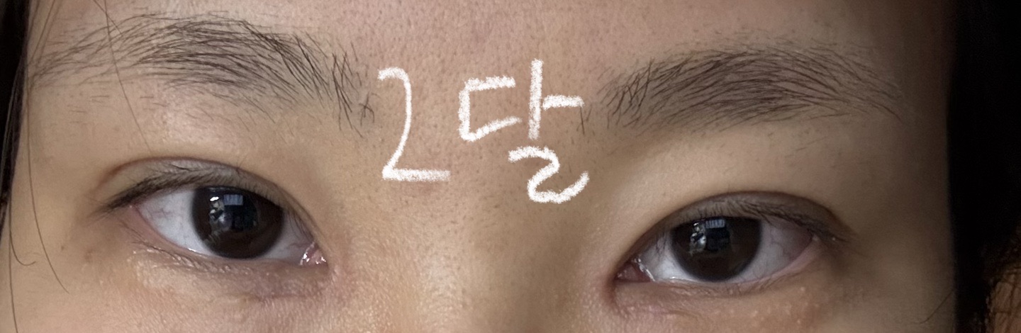 시술 후