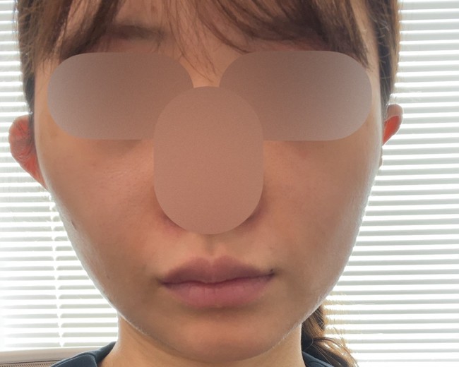 after photo: ウルトラセルQ+(ハイフ)