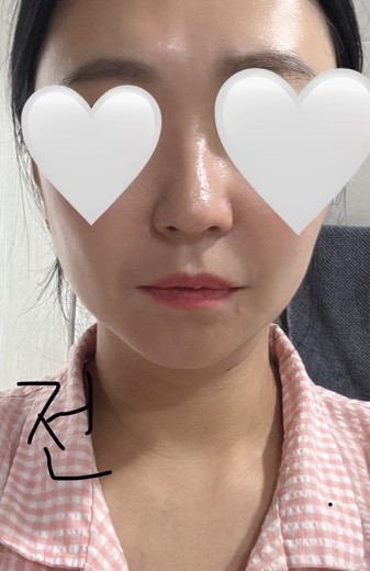 before photo: 콧대(보형물), 코끝(자가연골)