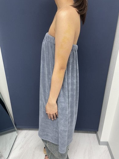 after photo: 脂肪吸引(腕)