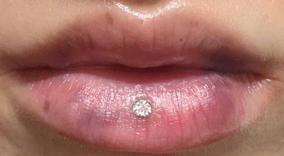 after photo: 필러제거주사