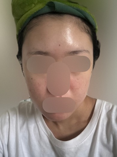 after photo: イオン導入