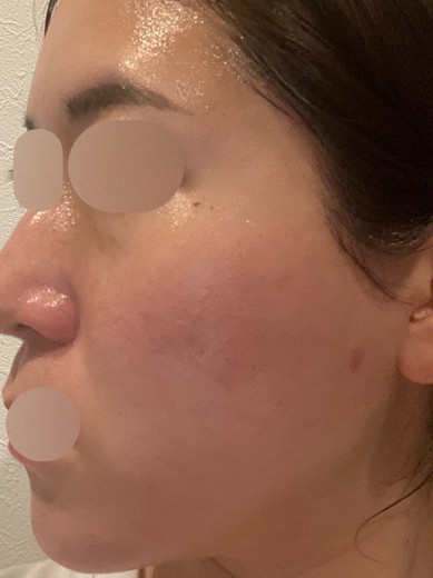 before photo: フラクショナルレーザー, ピコトーニング, 診断・検査