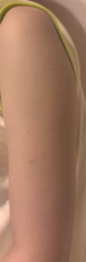 before photo: 脂肪冷却(腕)