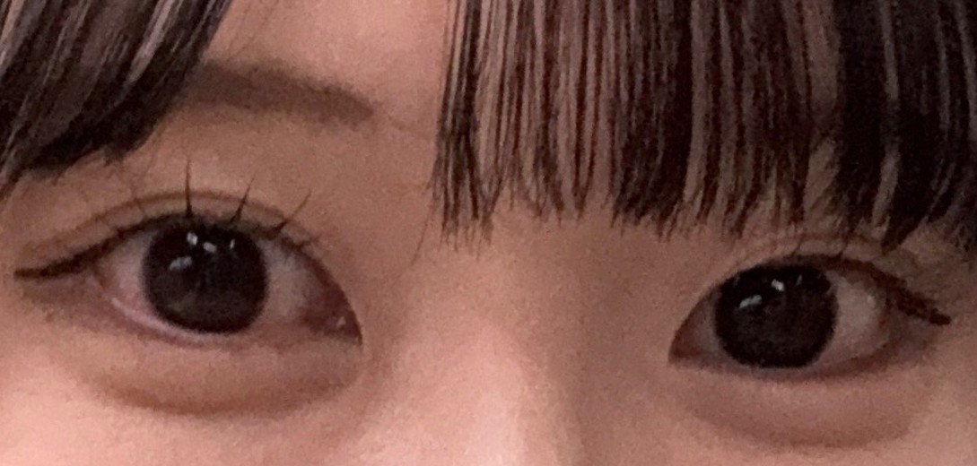 after photo: 涙袋ヒアルロン酸