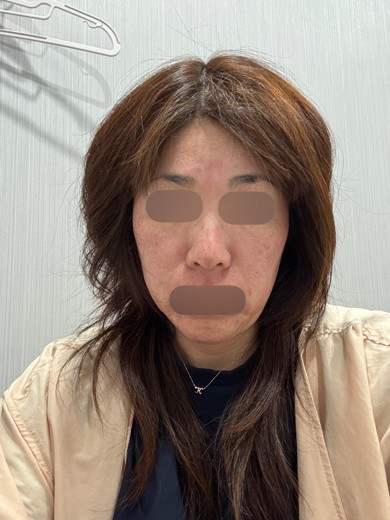 after photo: ヴェルベットスキン