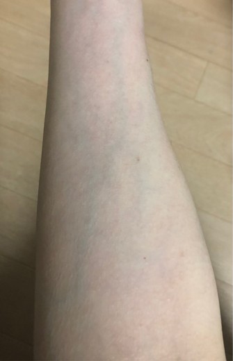 after photo: ビタミン注射・点滴