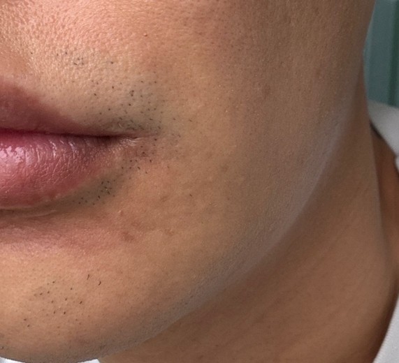 after photo: 인중제모