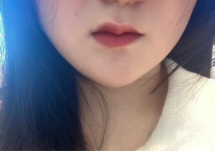 before photo: 입꼬리필러, 입술필러