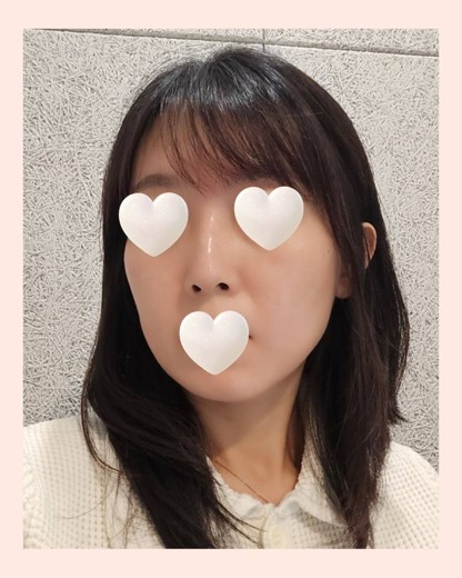 before photo: 티타늄리프팅