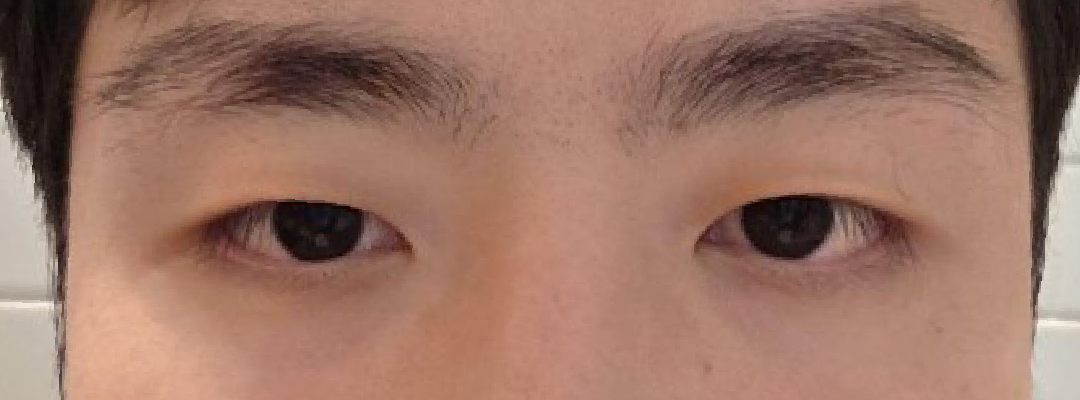 시술 전