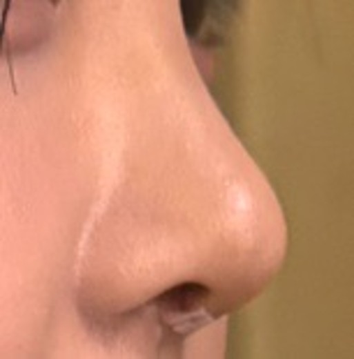 after photo: 콧대(보형물), 코끝(자가연골)