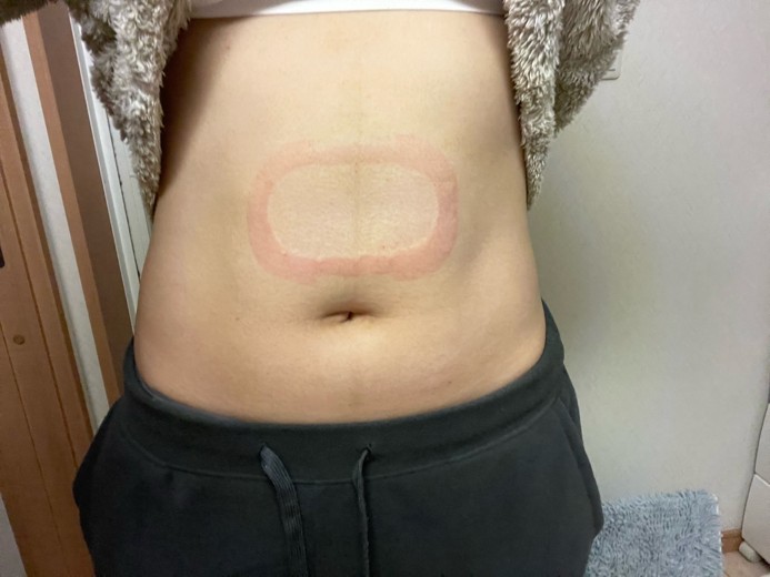 after photo: 脂肪冷却(腹部)