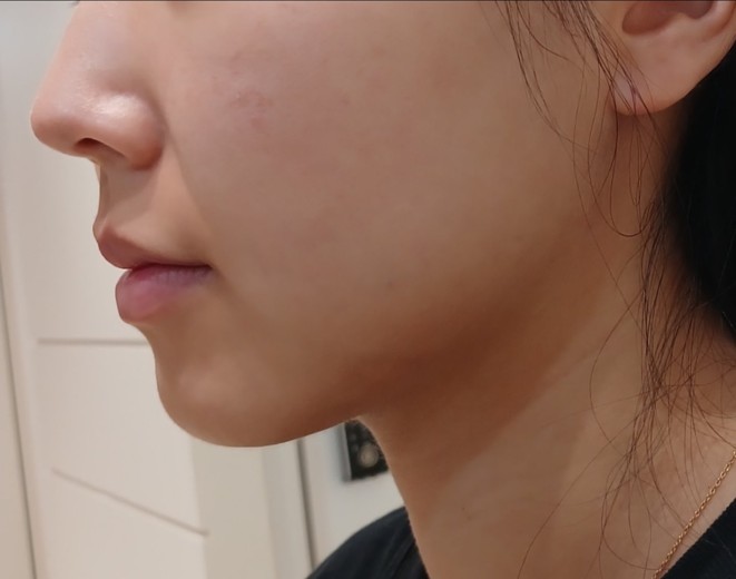 after photo: 인모드리프팅, 윤곽주사