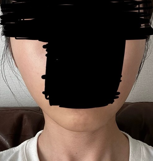 before photo: インモード