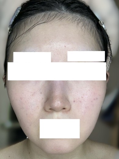 after photo: ジュベルック(Juvelook)