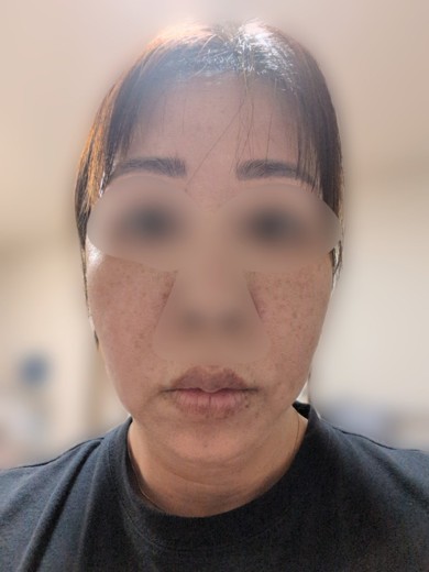 after photo: イオン導入
